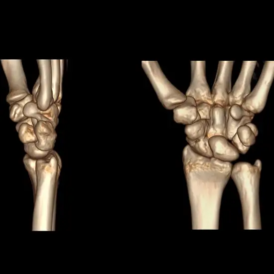 NCCT Right Wrist Joint